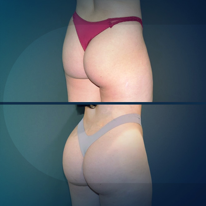 BBL (brazilian-butt-lift) - surgery-3