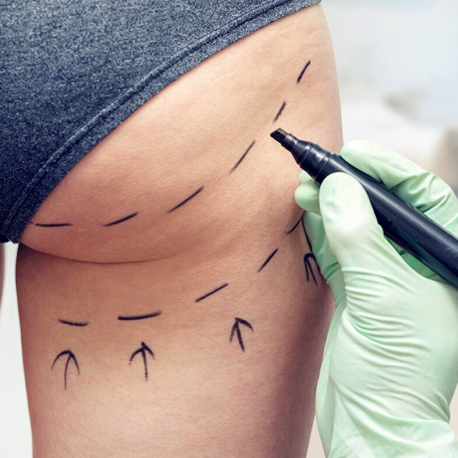 BBL (brazilian-butt-lift) - surgery-5