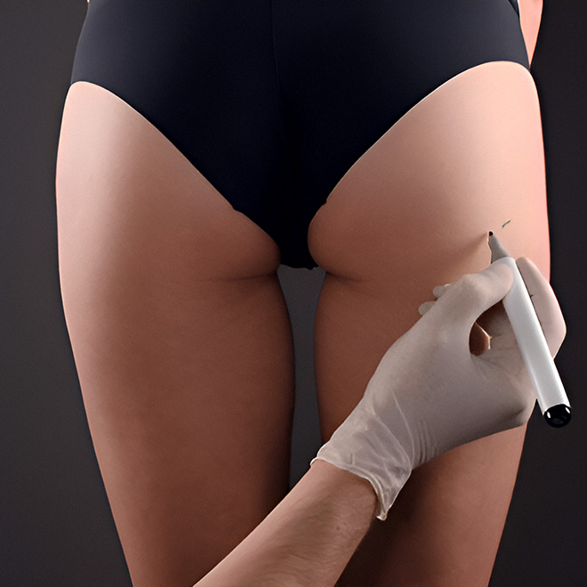 BBL (brazilian-butt-lift) - surgery-7