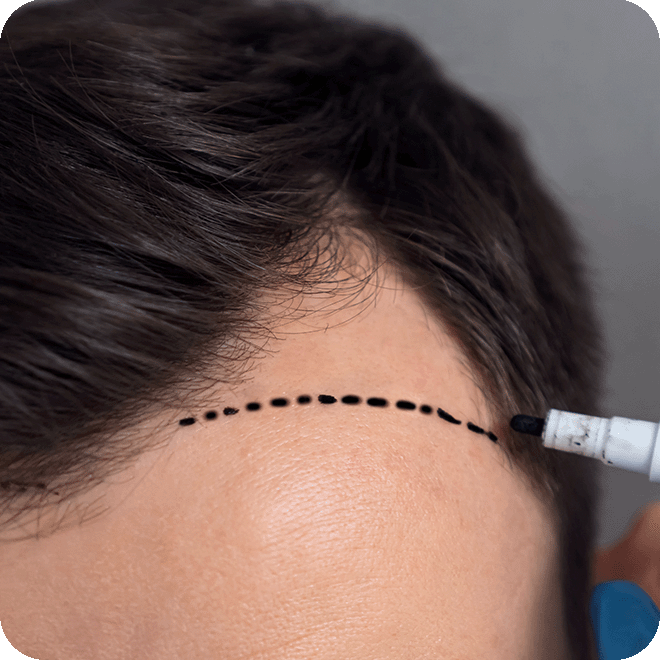 DHI-hair-transplant-10