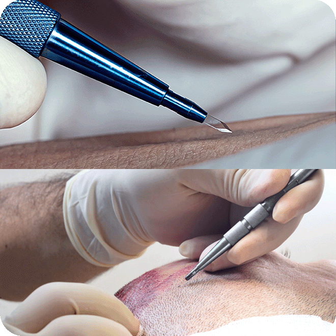 DHI-hair-transplant-12