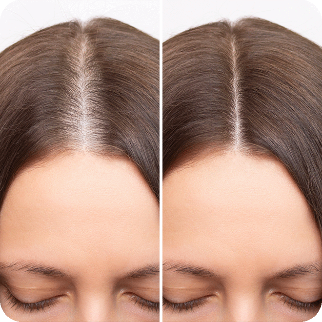 DHI-hair-transplant-14