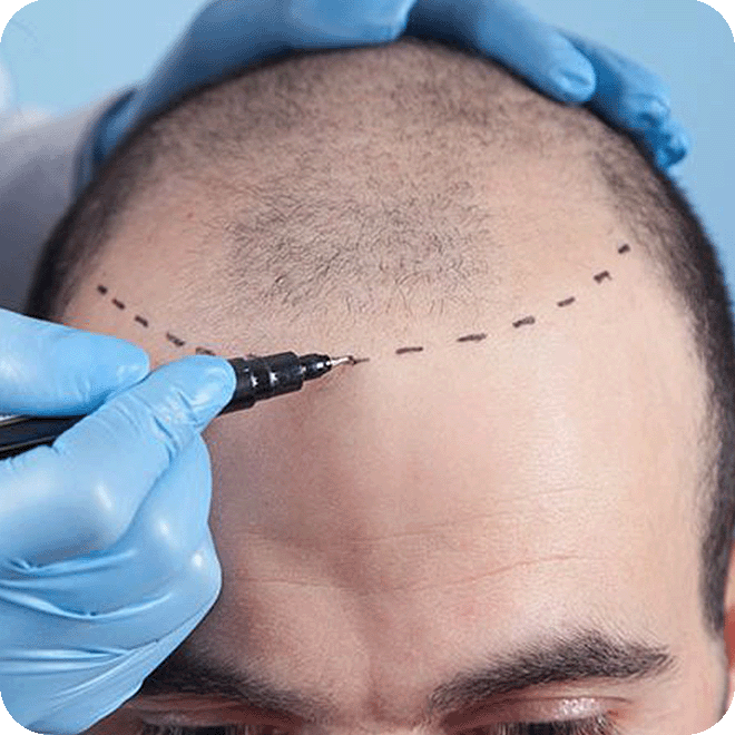 DHI-hair-transplant-15