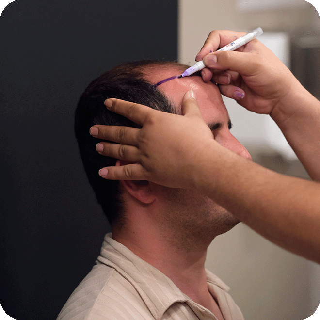 DHI-hair-transplant-16