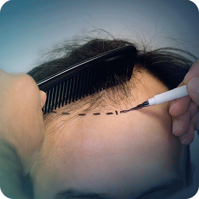 DHI Hair Transplant