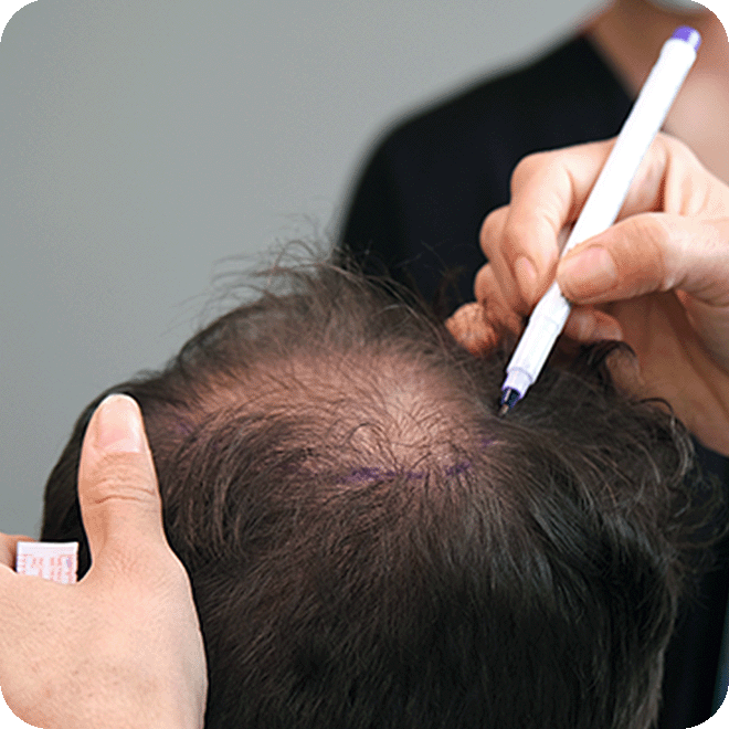 DHI-hair-transplant-6