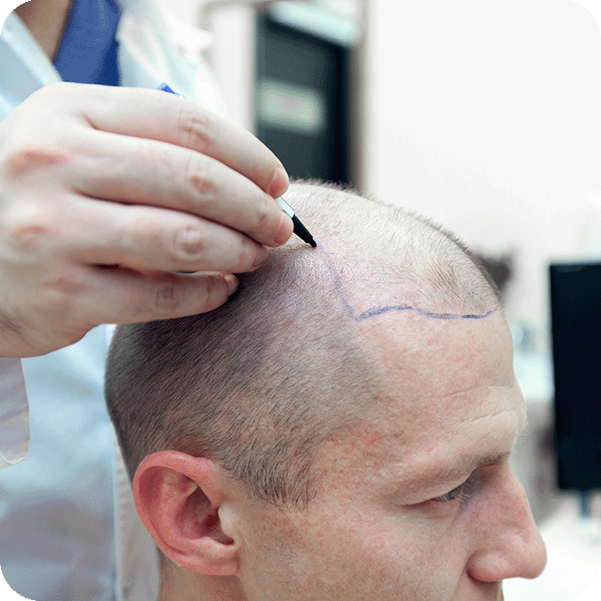 DHI-hair-transplant-8