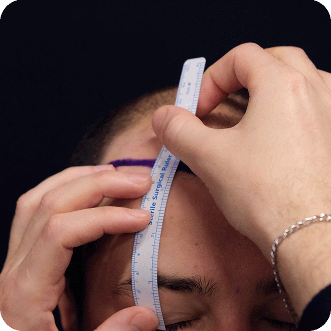 DHI-hair-transplant-9