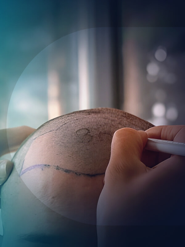 FUE-hair-transplant-3