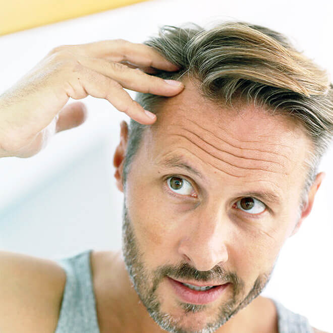 FUE-hair-transplant-4