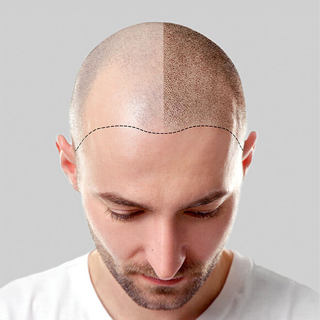 FUE-hair-transplant-5