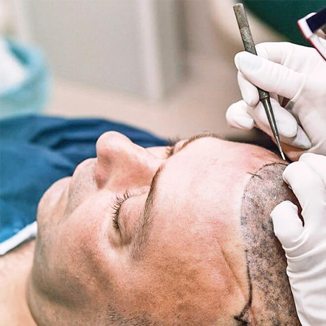 FUE-hair-transplant-8