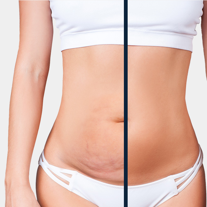 abdominoplasty-10