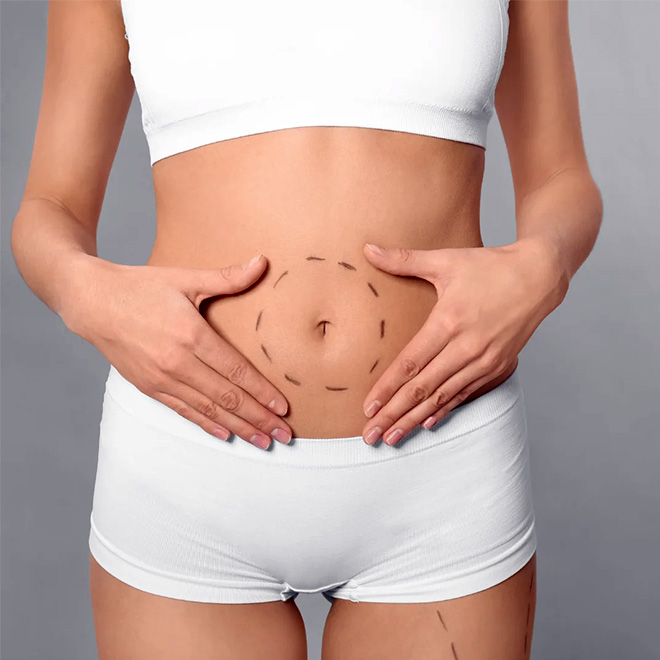 abdominoplasty-5