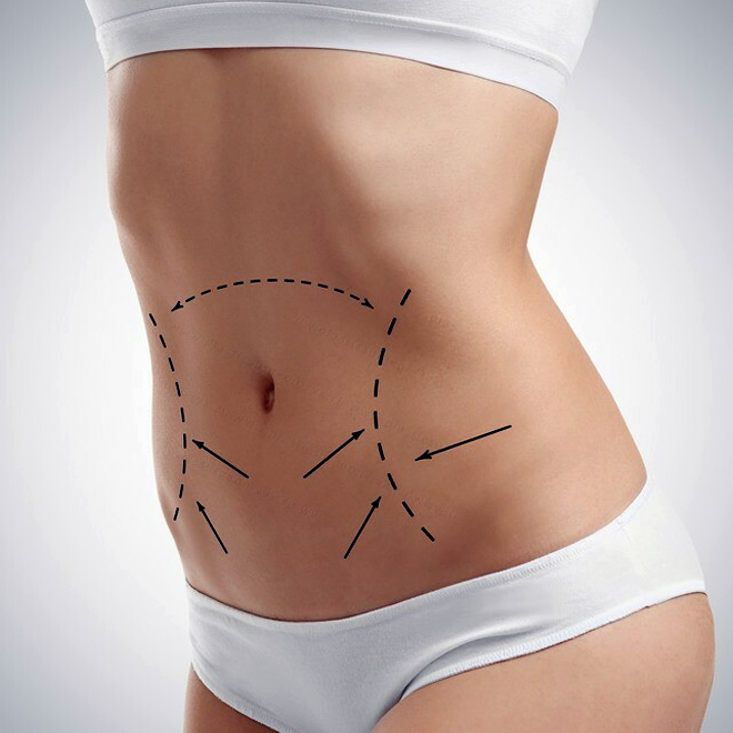 abdominoplasty-6