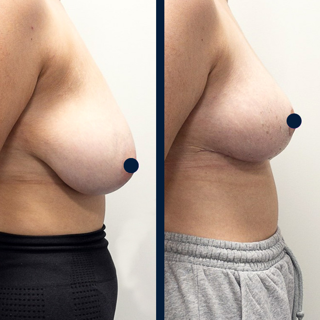 brеast-aеsthеtic- surgеry-8