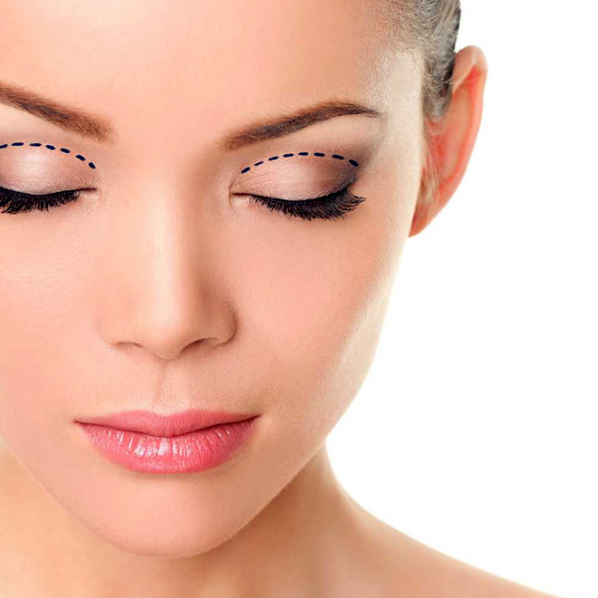 eyelid-surgery-9