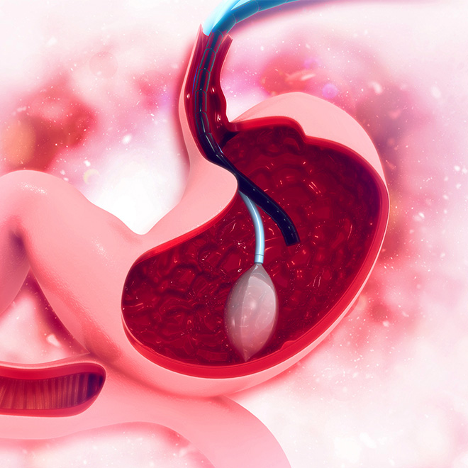gastric-balloon-4
