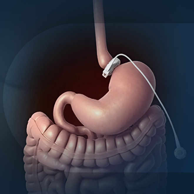 gastric-band-3