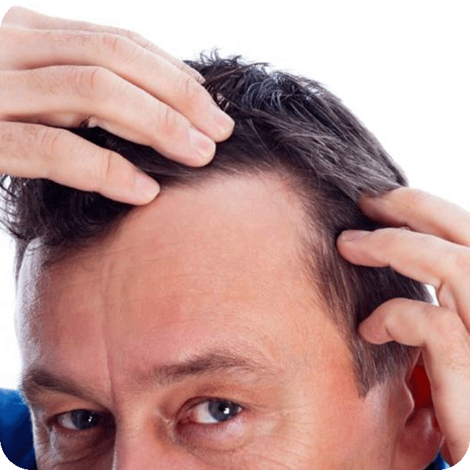 hair-loss-regenera-activa-11