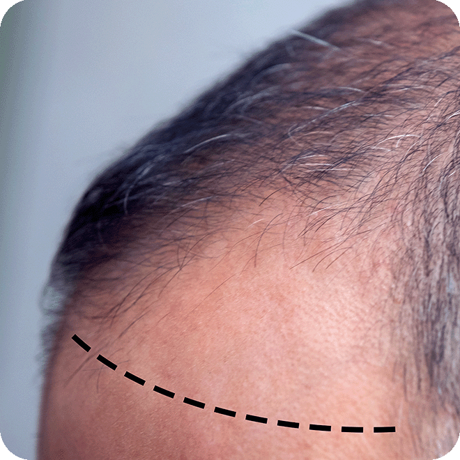 hair-loss-regenera-activa-5