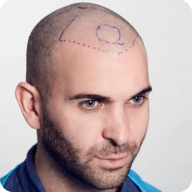 hair-loss-regenera-activa-8