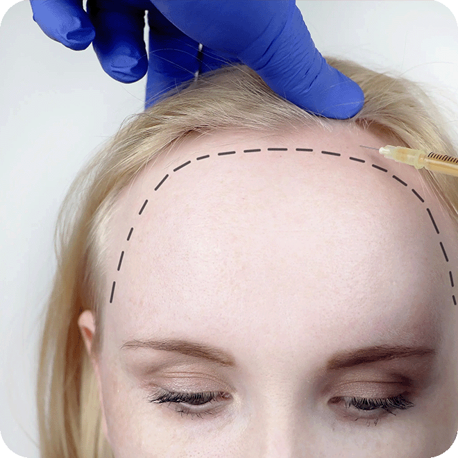 hair-transplant-for-women-11