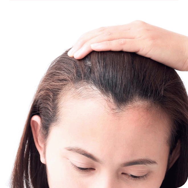 hair-transplant-for-women-4