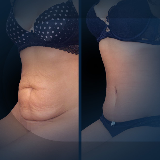 liposuction-3