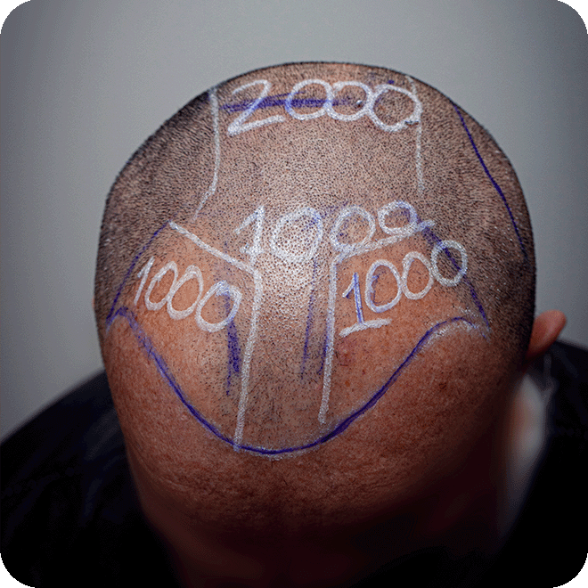 manuel-fue-hair-transplant-2