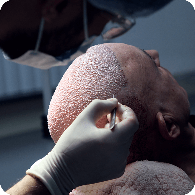 manuel-fue-hair-transplant-3