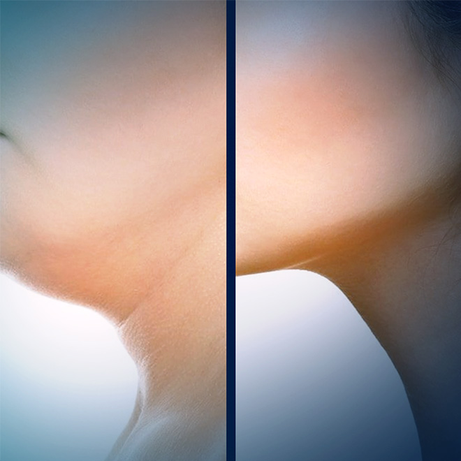 Neck Lift
