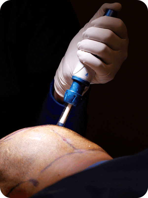 needle-free-hair-transplant-5