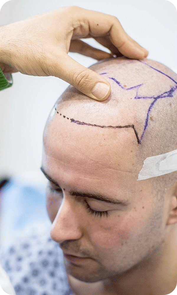 needle-free-hair-transplant-9