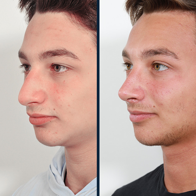 rhinoplasty-5