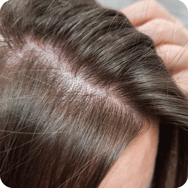 sapphire-fue-hair-transplant-10