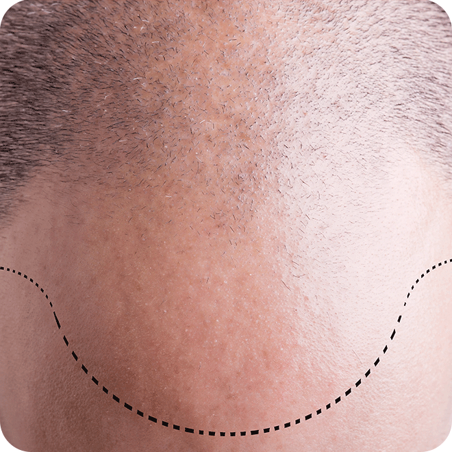 sapphire-fue-hair-transplant-11