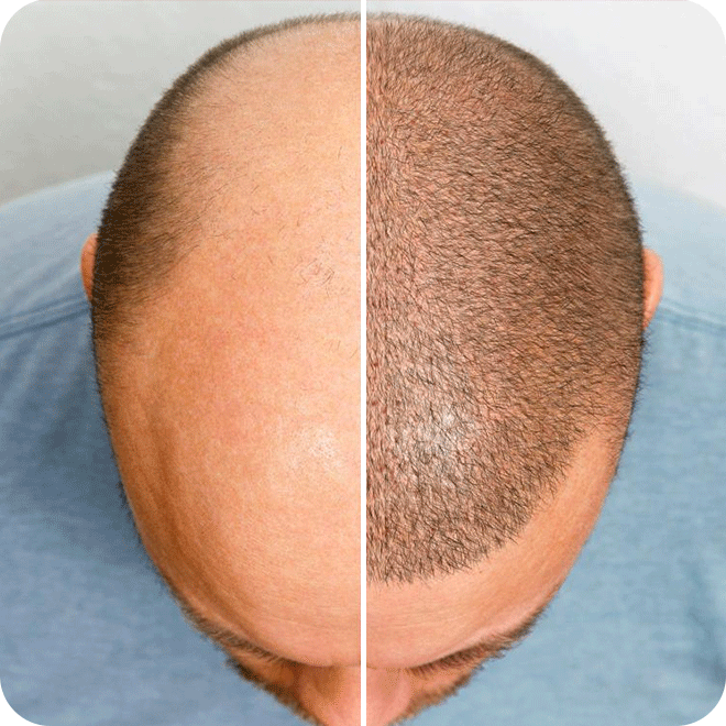 sapphire-fue-hair-transplant-12