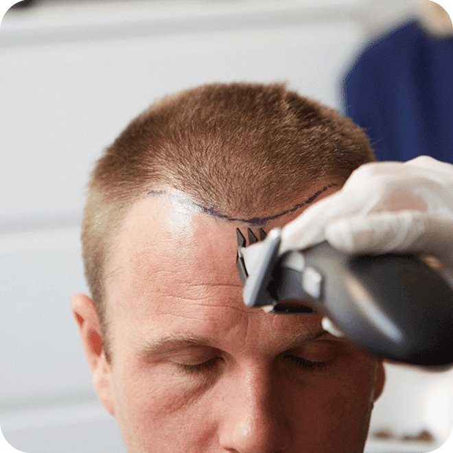 sapphire-fue-hair-transplant-13