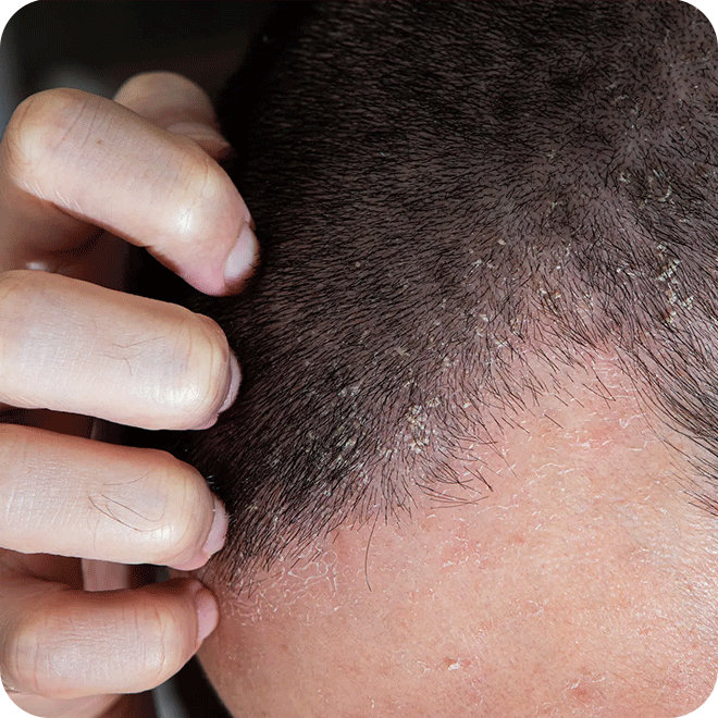 sapphire-fue-hair-transplant-14