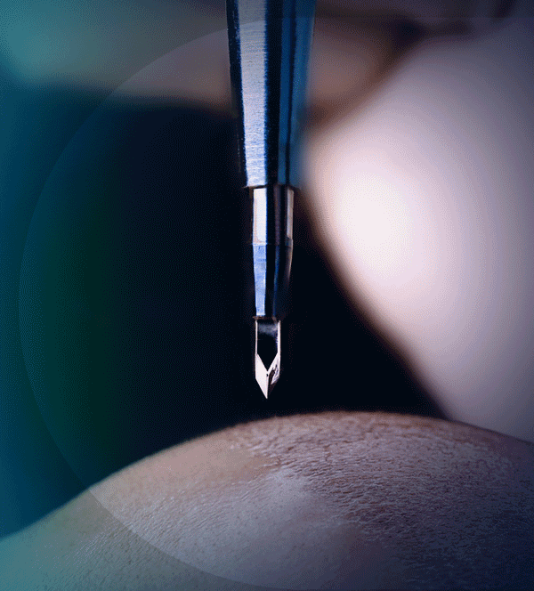 sapphire-fue-hair-transplant-3