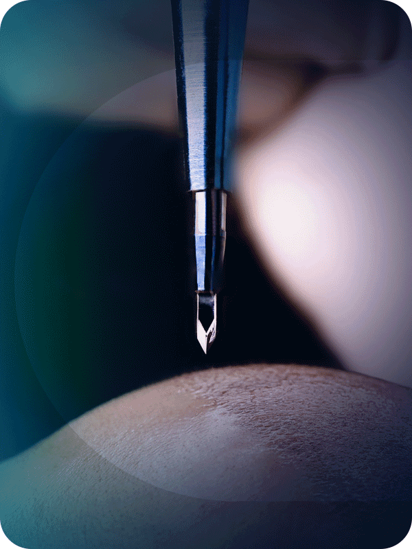 Sapphire FUE Hair Transplant