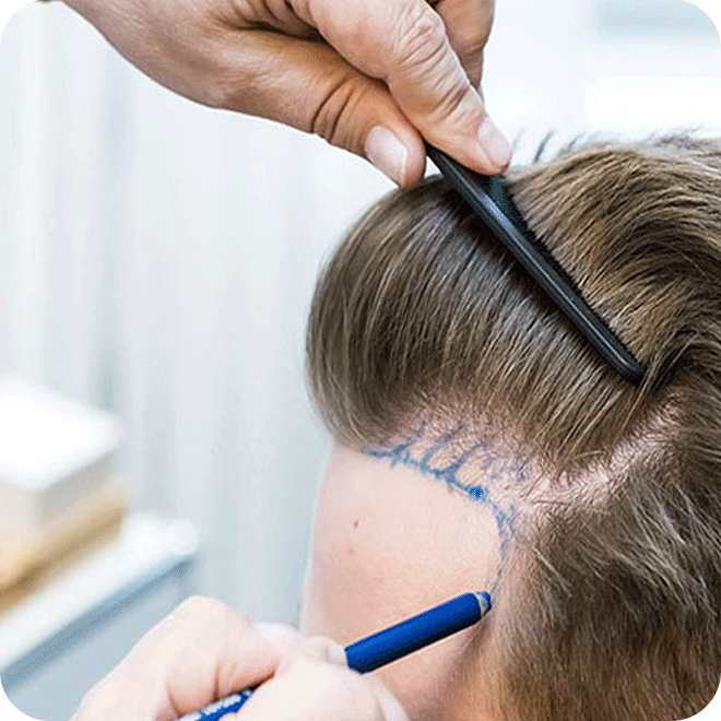 sapphire-fue-hair-transplant-5