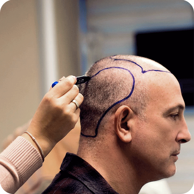 sapphire-fue-hair-transplant-6