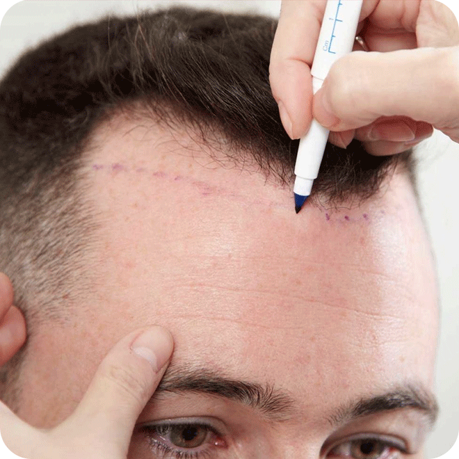 sapphire-fue-hair-transplant-7