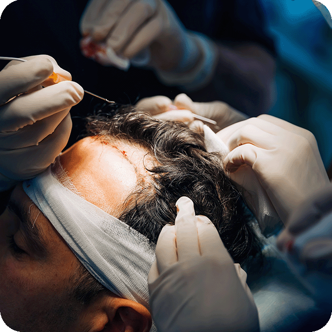 sedation-hair-transplant-3