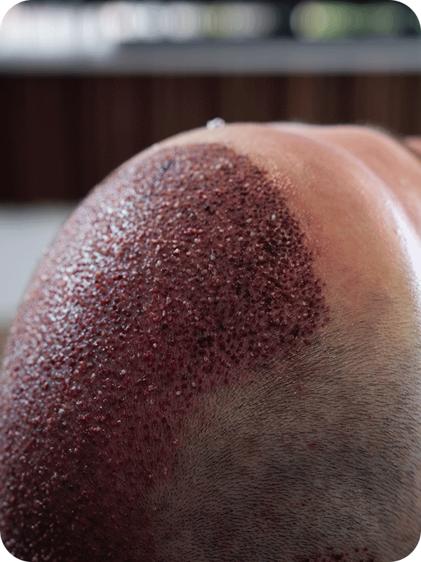 sedation-hair-transplant-4