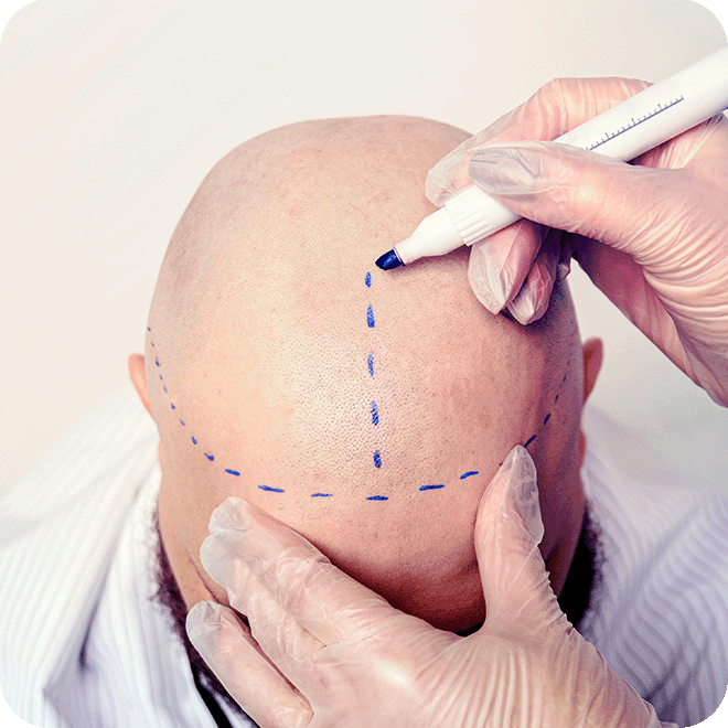 sedation-hair-transplant-6