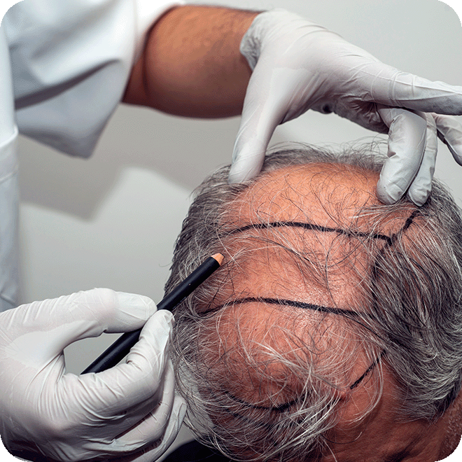 sedation-hair-transplant-7