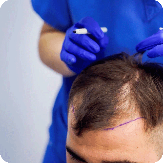 sedation-hair-transplant-9